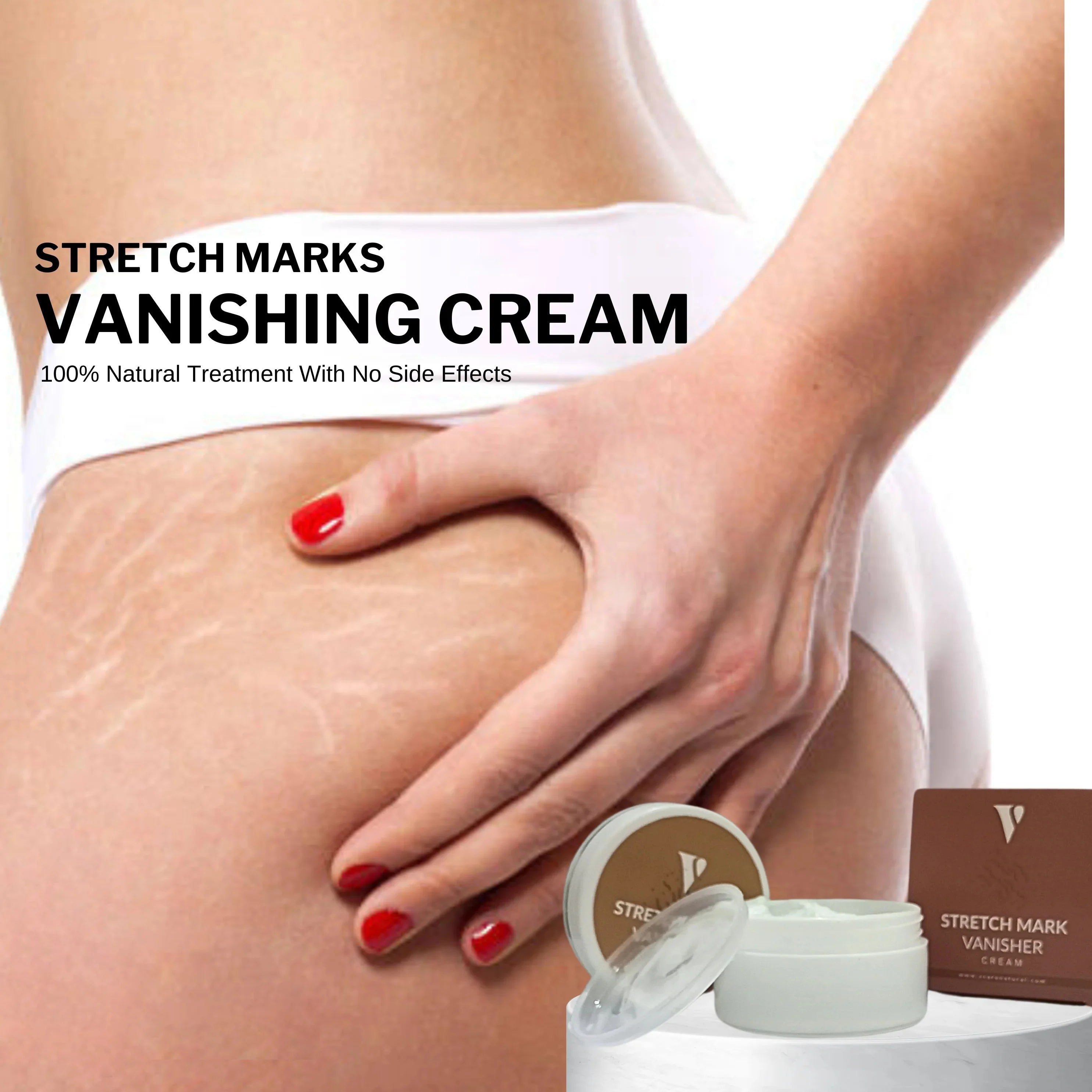 VCare Natural Stretch Mark Vanisher Cream