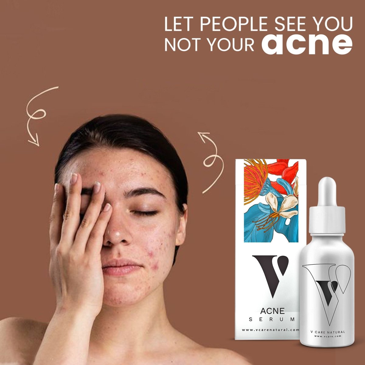 VCARE Natural Acne Serum - VCARE NATURAL